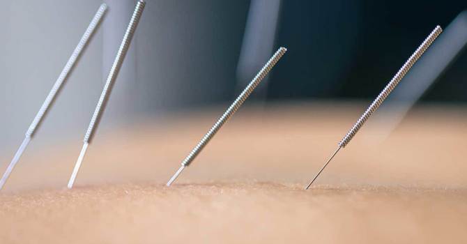 Acupuncture and Dry Needling